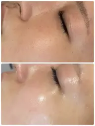 毛穴レスプレミアムエステ