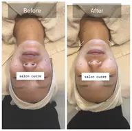 肌荒れ酷い方限定！ハーブピーリング🌿