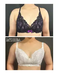 お背中二の腕痩身→M'DREAブラフィッティング