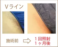 大人気箇所♡VIOお試し特別価格!通常13000円→半額!6500円