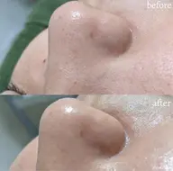 【💎毛穴引き締め最強ケア💎(顔脱毛+ハイドロスキン)】最新THR美肌脱毛と毛穴洗浄でお悩みゼロ肌へ🧖♀️❣️