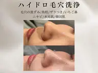 毛穴洗浄◇ハイドロフェイシャル【水光肌パック仕上げ/保湿・菌活】