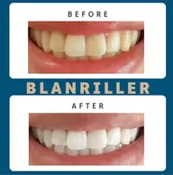 前回ご来店から1ヶ月以内のご予約で20%オフ❤️セルフホワイトニング15分×2回(30分照射)¥5000→¥4000🎶