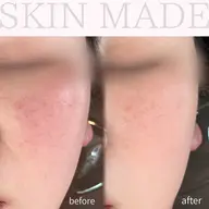 【赤み/ニキビケア】 鎮静×肌質改善🤍  ¥11,000→¥5,500