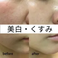 うる艶美肌【美白・くすみケア】剥けないハーブピーリング¥15,400→¥9,900(シルクパウダー)