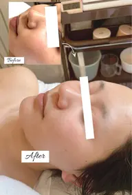 🫧フェイシャルエステ＋選べるオプション(ララピールor毛穴洗浄orヘッドマッサージ)💆‍♀️