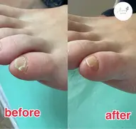 副爪【フクソウ】ケア(小指の爪横に出来た角質ケア)痛み、厚み、靴下に引っかかったりする角質です