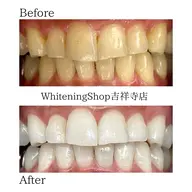 【✨口コミ記載の方78%OFF!✨】お試し 照射パワー100%!たっぷり45分間照射‼️