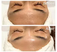 《しわ&たるみ+最強エイジング👩🏻⚕️🏅》韓国肌管理ララピールフルコース🤍+エレクトロポレーション美容液導入