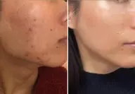 プラズマニードル ＋エクソソムフェイシャル