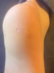 痛いウオノメとります1個