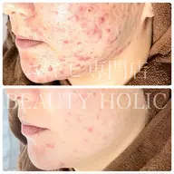 皮膚科に行っても治らなかった繰り返すニキビにお悩みの方😖もうニキビに悩みたくない‼️という方向けです✨