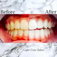 ✨一番人気✨【🔥圧倒的効果🔥】通常の6倍照射!セルフホワイトニング9,800円👗