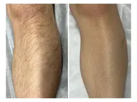 【新規男性/初めての脱毛で迷ったらこれ！】ひげ込VIO無全身脱毛体験¥11000