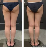 初回限定⭐️セルライト撲滅👊🏻むくみ撃退👣脚やせ60分¥16500→¥3980