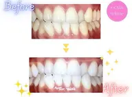 【minimo掲載記念✨️】セルフホワイトニング【9分✕2回】¥390別途料金なし