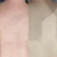 【イベント前に🌈】うなじ+背中脱毛