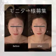 【モニター様＊basic menu】頭蓋骨小顔矯正　通常13,000円→初回7,000円