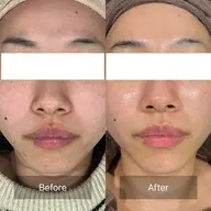 【人気No.1✨】【ご新規様限定】1ヶ月集中モニター🥚最大4回のエステ付き