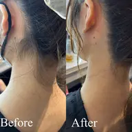 👶🏻4月限定うなじ脱毛👶🏻