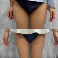 【しっかり変化】8cc｜二の腕や内ももなど本気の脂肪ケア🍋