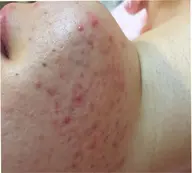 🔶美顔🔶【サウナ+毛穴+ニキビケア】17種類ミネラル・ビタミンC導入美白! 女性限定