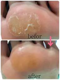 タコ、魚の目ケア