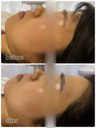 💎小顔スペシャルケア💎【脂肪撃退美容液導入×リフトアップ1パーツ】1回で効果実感の声あり