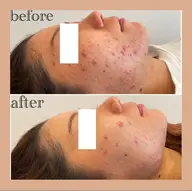 ツヤ肌ハーブピーリング