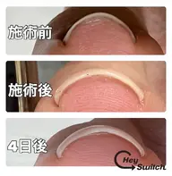 🇰🇷韓国より初上陸✨今話題の巻き爪ケア🦶ヘイスイッチ取り扱い店✨