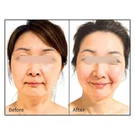 【たるみ・二重アゴ・ほうれい線 改善 】リフトアップエステ