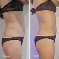 【話題の脂肪痩身マシン】✨LUMIX LIPOCOOL✨1カップ