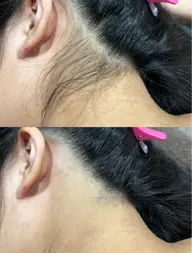 ✨4月オープン価格✨新生活応援🌸後ろ姿美人🩷意外と見えるうなじ脱毛