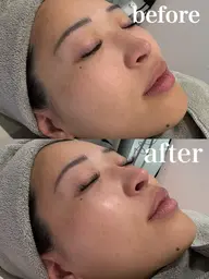 【2名様限定】韓国肌管理水光ララピール＆エレクトロポレーション導入✨小顔コルギマッサージ付🕊️