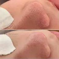 毛穴エクストラクション(炭酸ヘッドマッサージ付き)