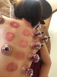 吸い玉デトックス60分