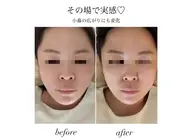 【小顔集中】顔インナー◎1ヶ月通い放題24,800