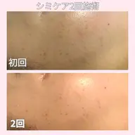 本気のシミ集中ケア！初回限定5,180円✨