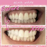 【minimo掲載記念✨️】継続率90%以上!!セルフホワイトニング【9分×2回】¥390　別途料金なし