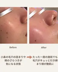 【先着5名様✨SNSモニター】最新4in1次世代ピーリング+酸素導入(90分)江戸川区初導入マシン