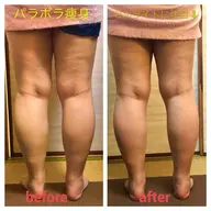 パラボラ痩身(両脚)