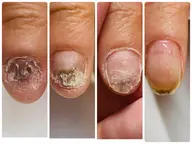 【深爪矯正★男性ハンド】お試し1回体験