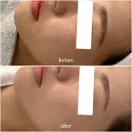 花粉からのぷつぷつ・吹き出物ケア🤧 ダウンタイムなし！ソフトピーリング＋超音波毛穴洗浄＋フェイシャルマッサージ♩