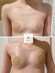 新時代バストアップ🎀メスを使わない豊胸🌙脂肪増加剤導入！背中/バスト/デコルテマッサージ付き