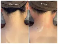 【意外と見られている👀】後ろ姿美人✨うなじWax脱毛&SHR光脱毛💓