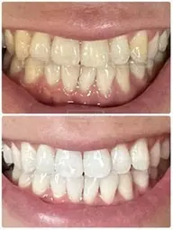 【効果を実感✨30分】セルフホワイトニング15分✕2回《¥4,000》