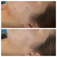 もう二度と悩まされない!最終のニキビケア