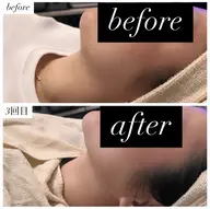 最新韓国美容二重顎リバウンドなし◎