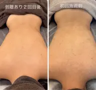 🌿ニキビ痕のお悩みに‼️剥離ありクリニカルハーブピーリング〈背中〉〈二の腕〉〈お尻〉〈顔〉選べる部位