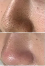 毛穴の黒ずみ鼻のみコース 5,500円